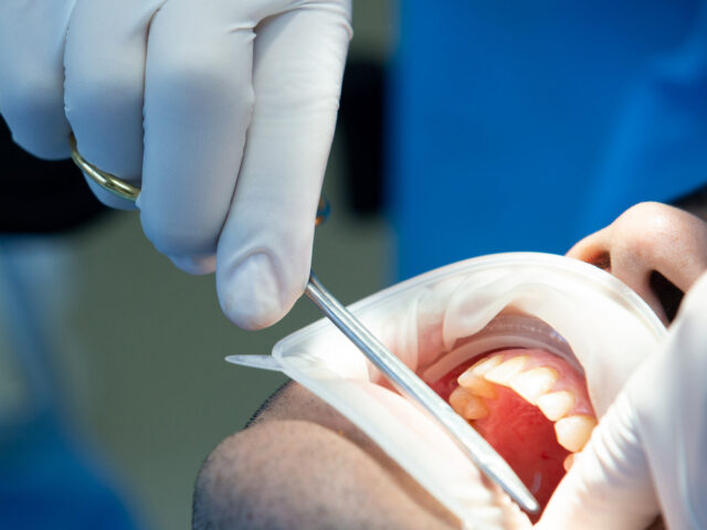 https://szedinadental.hu/wp-content/uploads/2022/09/dentist-with-tool-makes-some-manipulations-patient-s-mouth-640x480.jpg